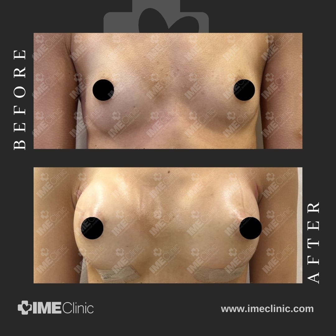 
                                     A before-and-after image showing a persons chest. The top image shows the chest before breast augmentation, and the bottom image shows the chest after the procedure, with visible enlargement. Both images have black circles covering the nipples.